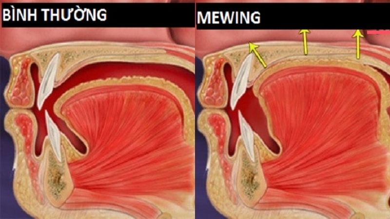 Xác định vị trí đặt lưỡi khi tập Mewing