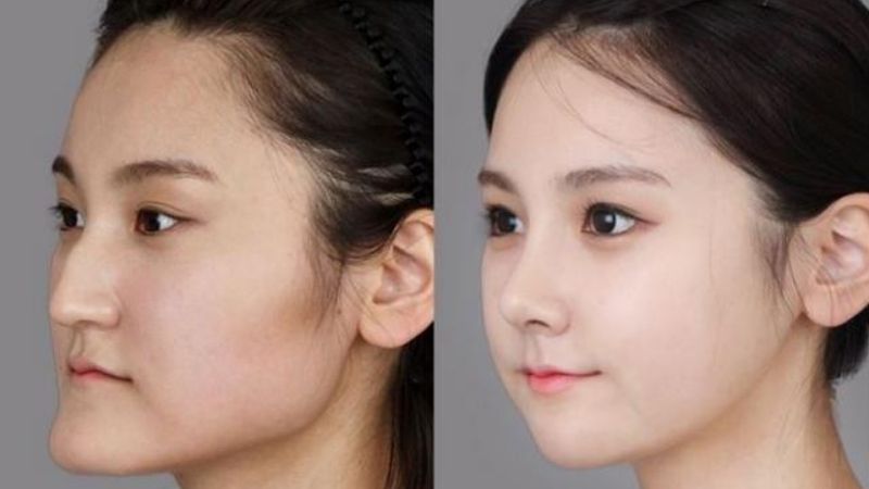 Mewing có thể cải thiện tình trạng bị móm