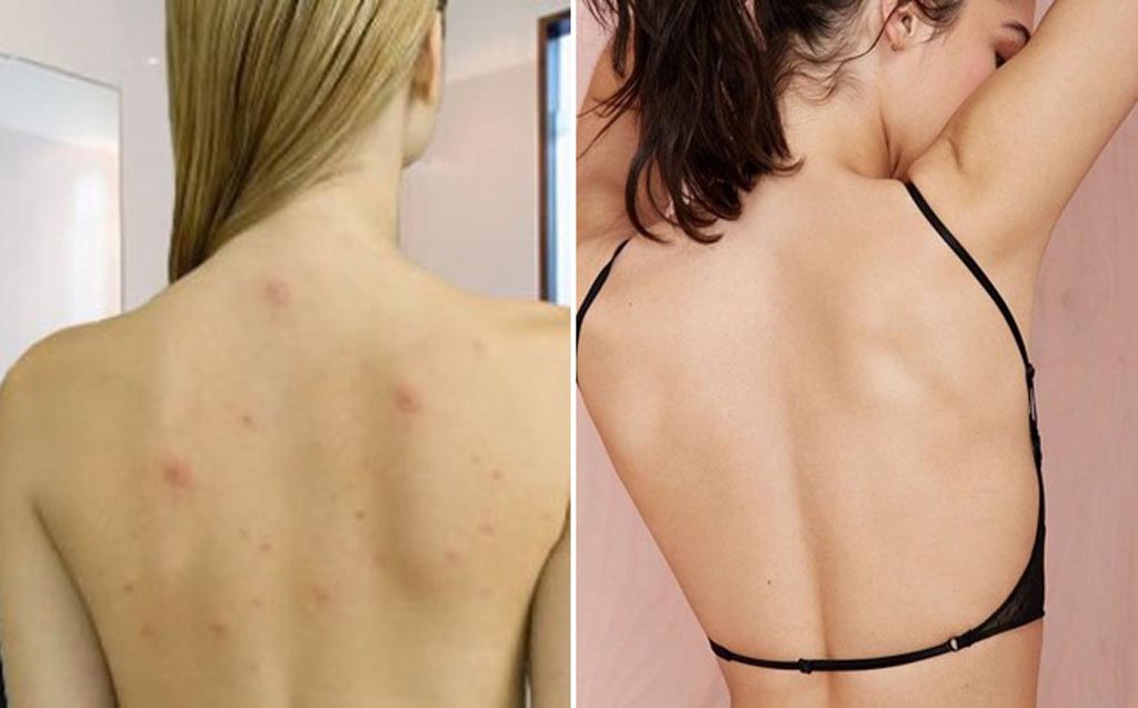 5 Sai Lầm và 5 Thói Quen Giúp Da Lưng Sạch Mụn, Mịn Màng