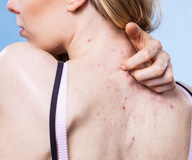 5 thói quen tưởng vô hại khiến mụn lưng mọc dày, trị mãi không hết, chỉ thay đổi 1 bước khi gội đầu có thể cải thiện rất nhiều - 1